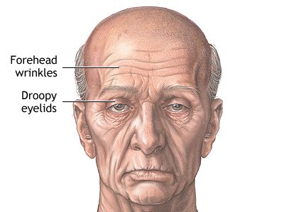 Illustration of an elderly male face highlighting forehead wrinkles and droopy eyelids, commonly treated with brow lift or upper eyelid surgery