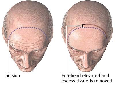 Medical illustration showing forehead lift surgery, with incision placement along the hairline and removal of excess forehead tissue to elevate the brow