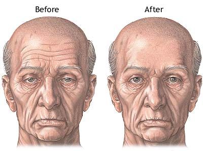 Before and after comparison of an elderly male patient showing the effects of forehead lift surgery, highlighting smoother forehead lines and elevated brow position