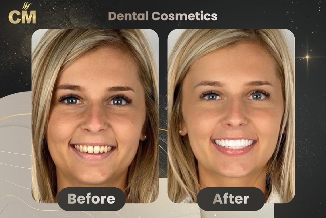 Hollywood Smile Before and After in Turkey