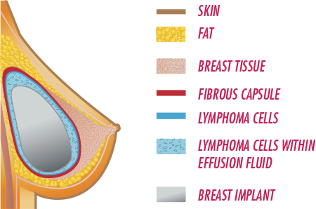 ALCL Breast Layers