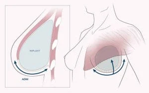 Acellular-dermal-matrix-and-implant-ping