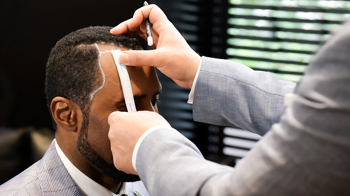 Surgeon outlining the hairline on a patient with afro-textured hair during pre-transplant consultation, demonstrating precision in hair restoration planning.