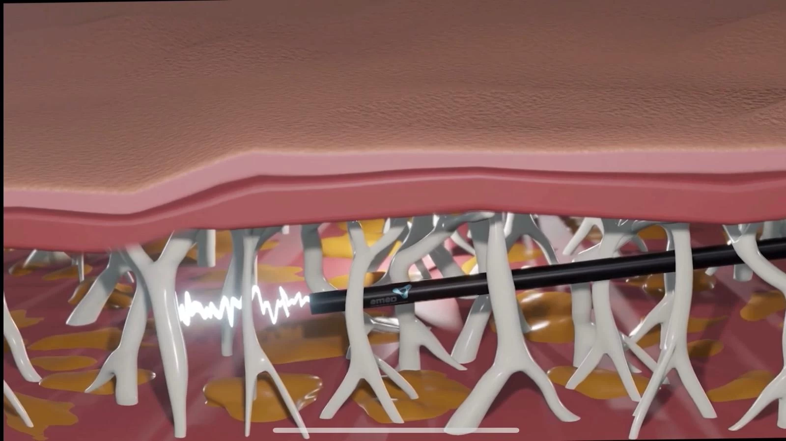 Argon Plasma Liposuction clinmedica