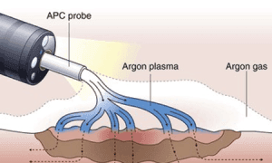 Argon Plasma Liposuction in Turkey
