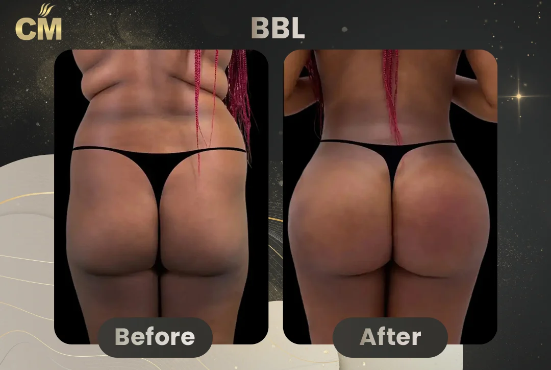 BBL Before and After-6