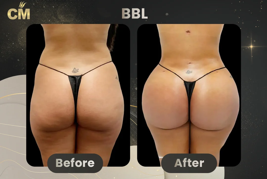 BBL Before and After-8