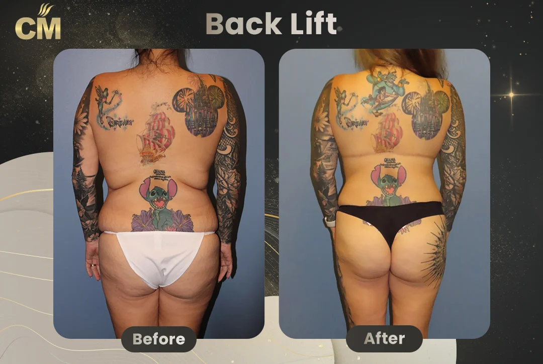 Bra Line Back Lift Before After clinmedica
