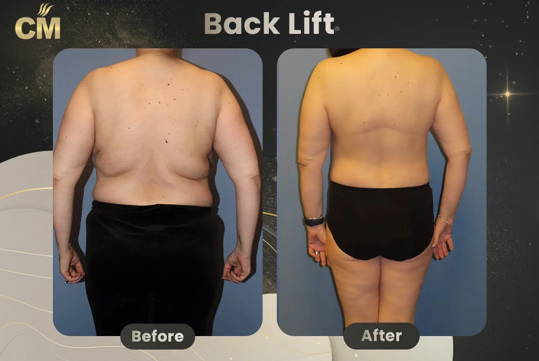 Bra Line Back Lift Before After clinmedica 1