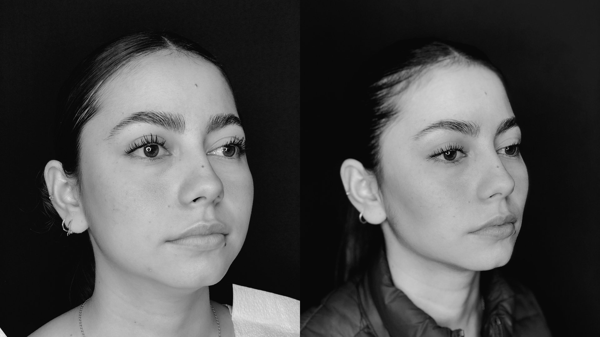 Before and After Bichectomy