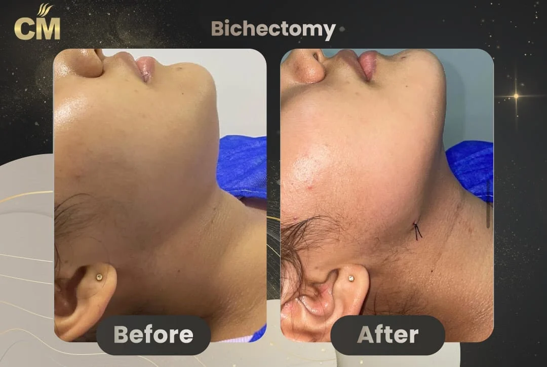 Bichectomy Before and After