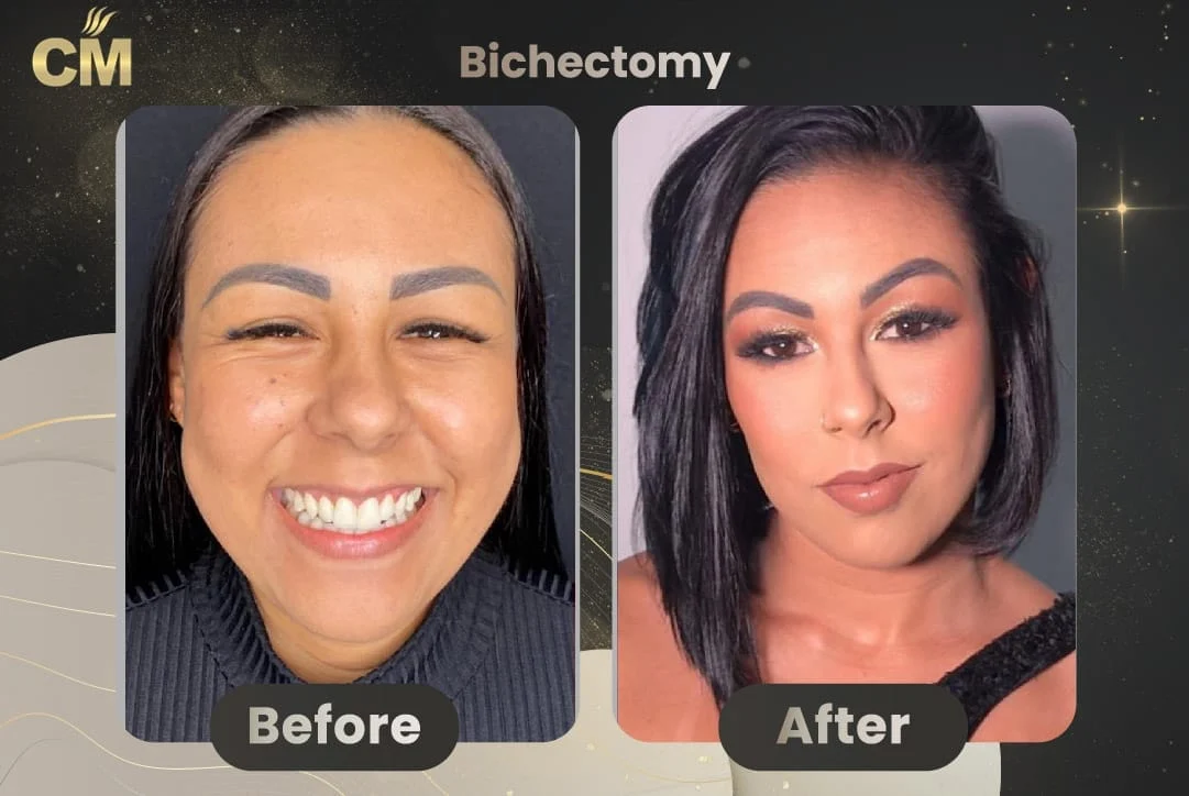Bichectomy Before and After-4