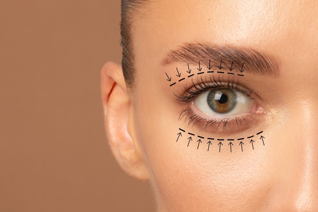 Blepharoplasty surgery