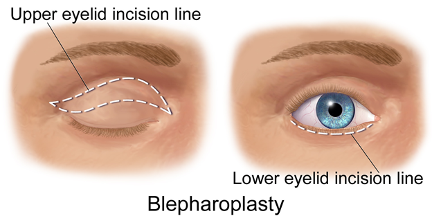 how Blepharoplasty surgery done in turkey