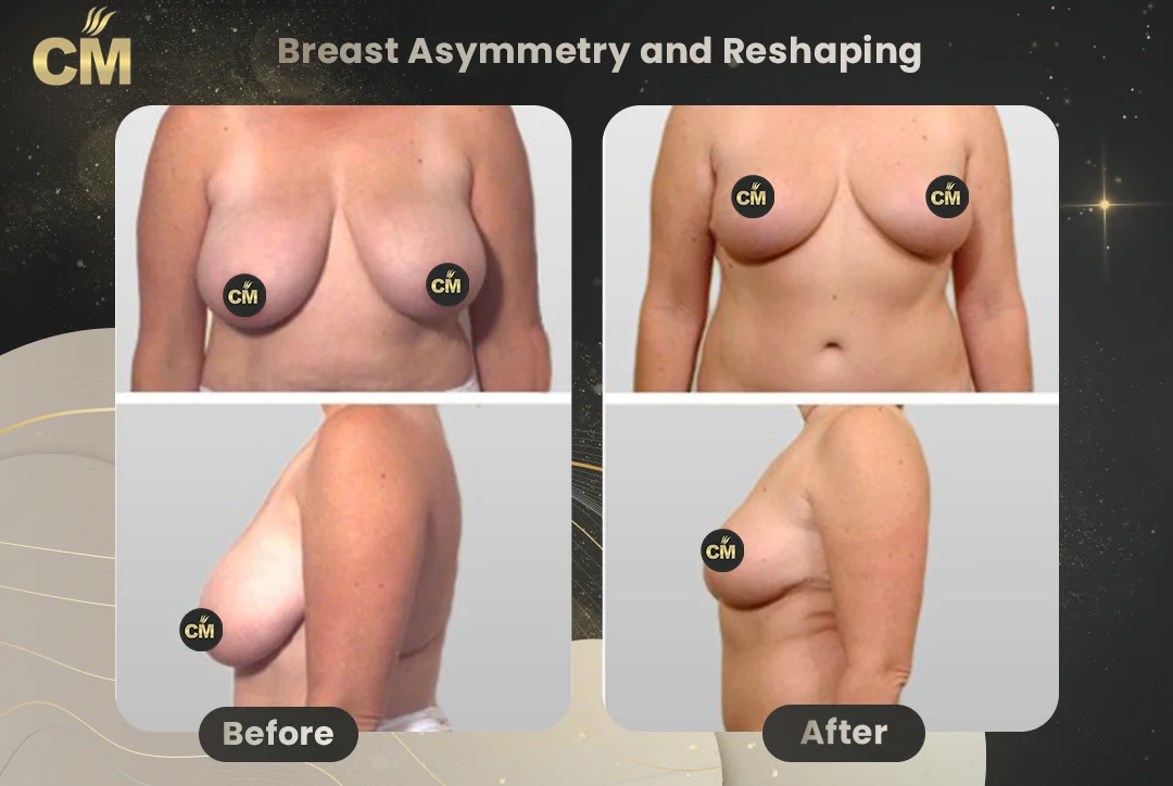 Breast Asymmetry and Reshaping Before After-1