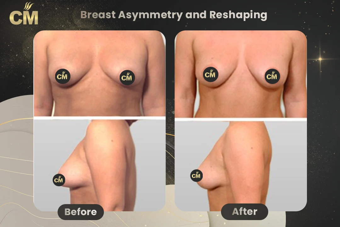 Breast Asymmetry and Reshaping Before After-2