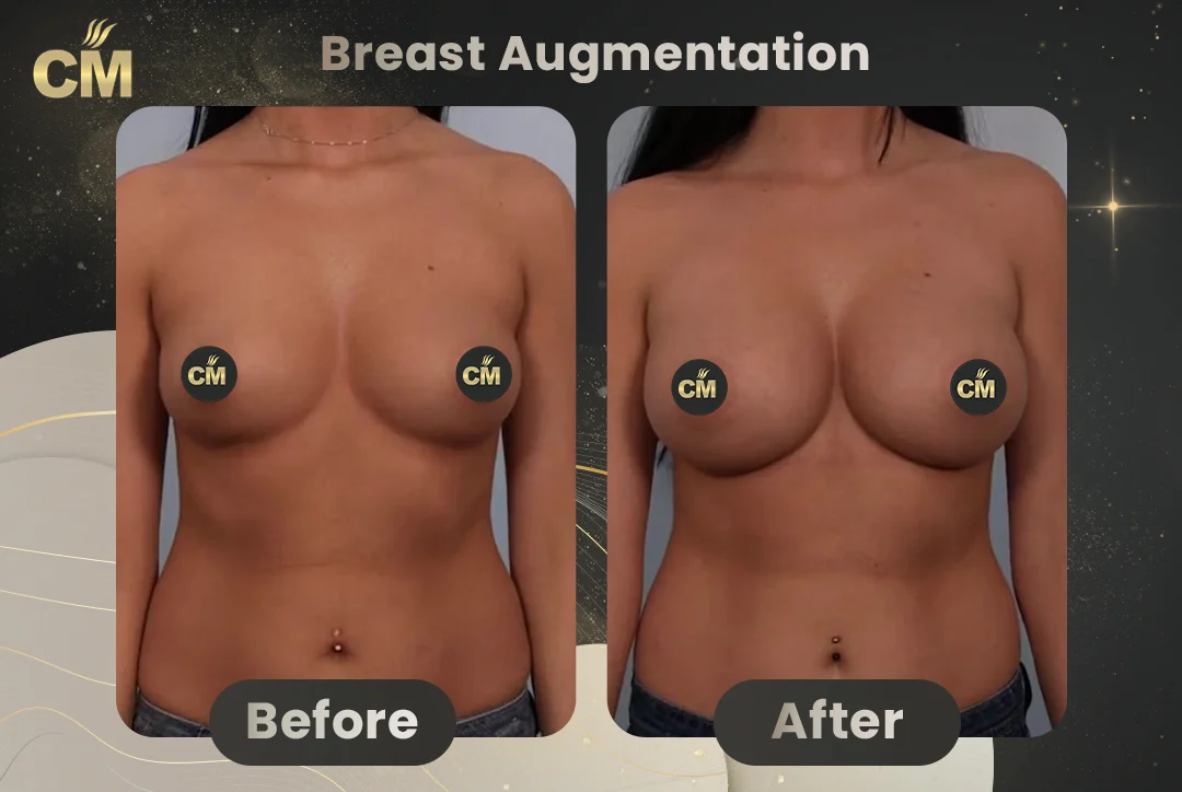 Breast Augmentation Before After-6