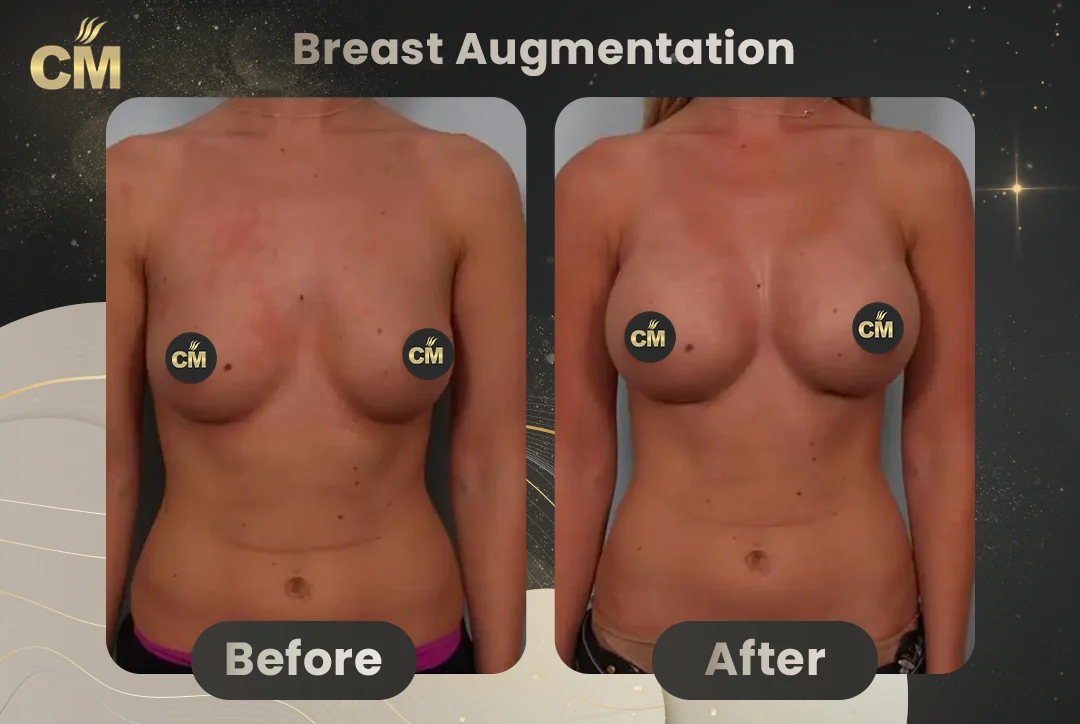 Breast Augmentation Before After-7