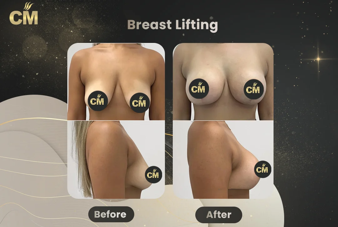 Breast Lift Before After-2