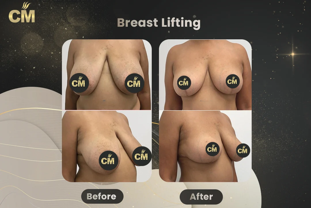 Breast Lift Before After-2