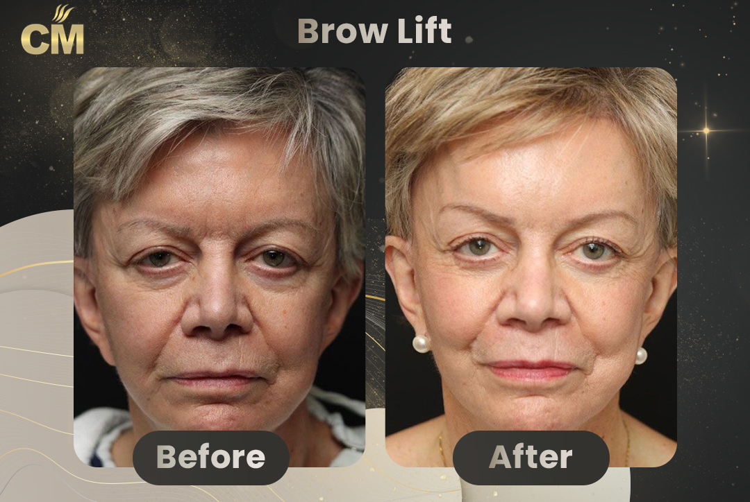 Forehead Lift Before and After