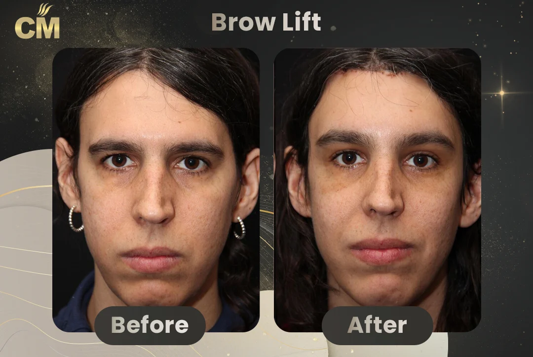 Forehead Lift Before and After9