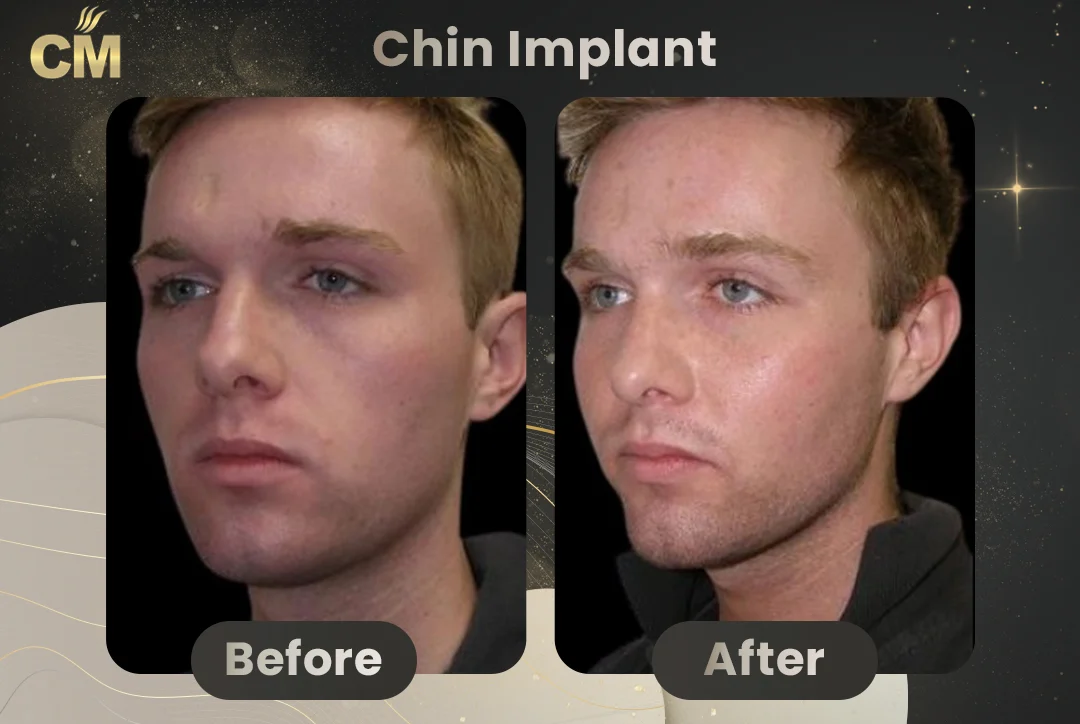 Chin Implant Before and After for men