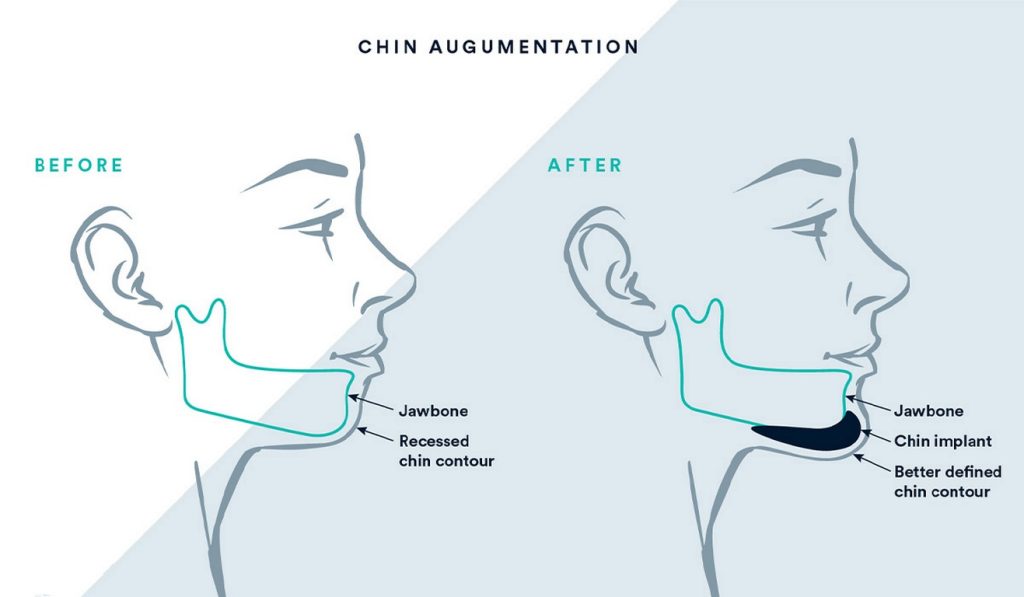 Chin Implant surgery in turkey