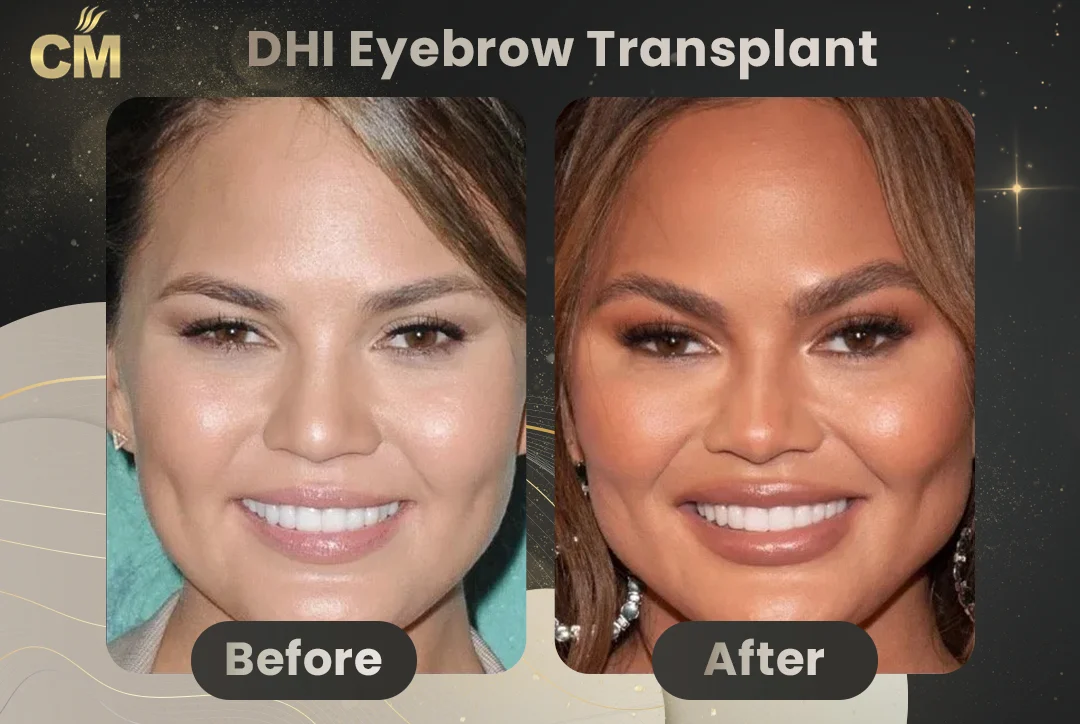 Eyebrow Transplant Before After-9