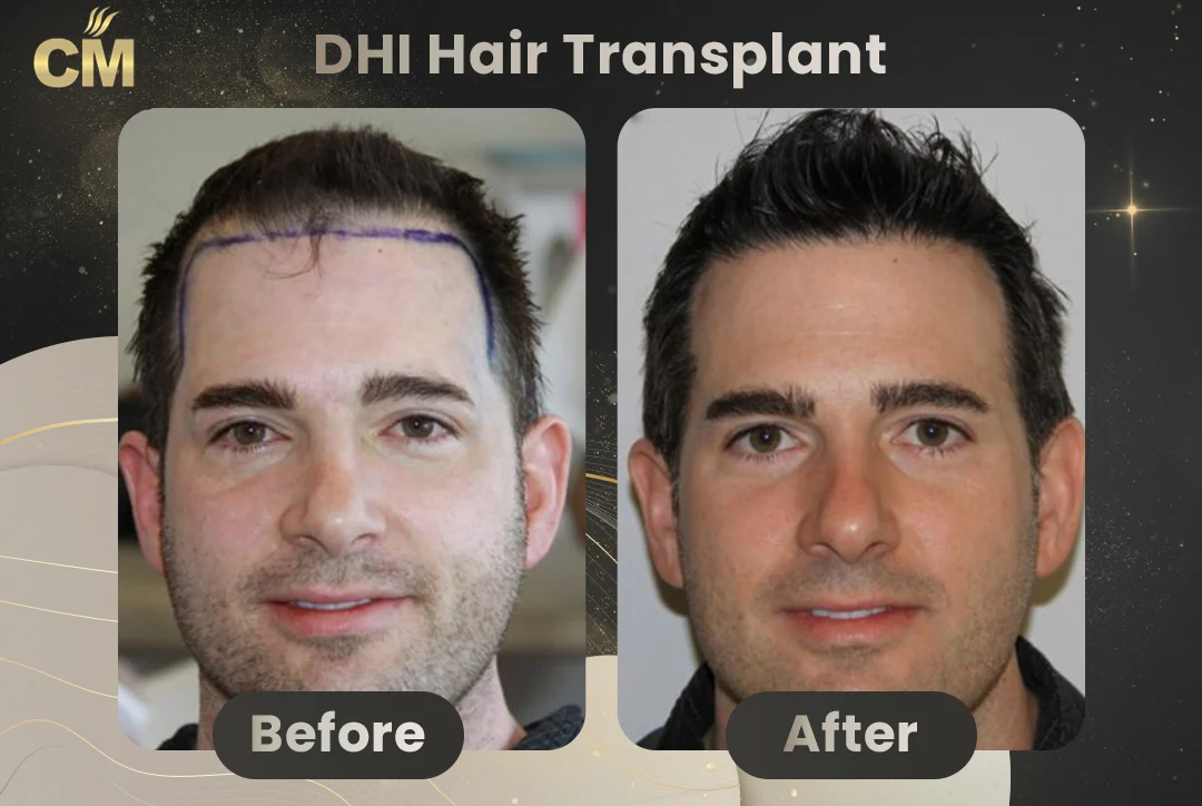 DHI Hair Transplant Before and After in Turkey-25