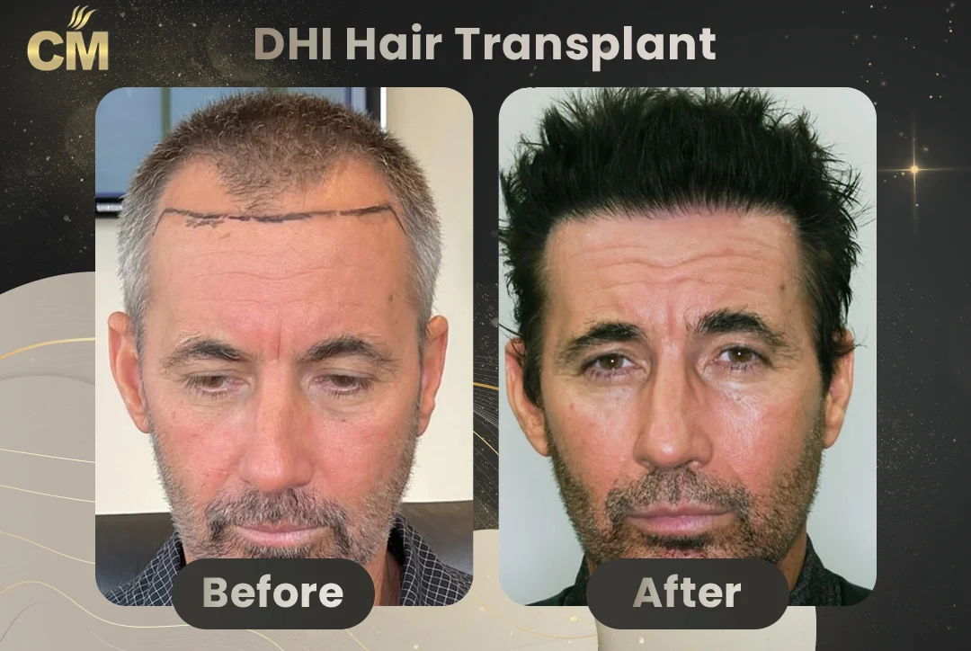 DHI Hair Transplant Before and After in Turkey-9
