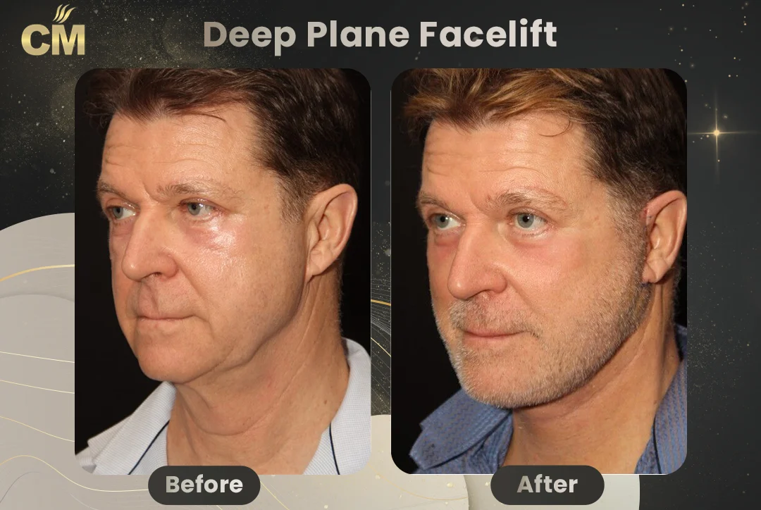 Deep Plane FaceLift Before After