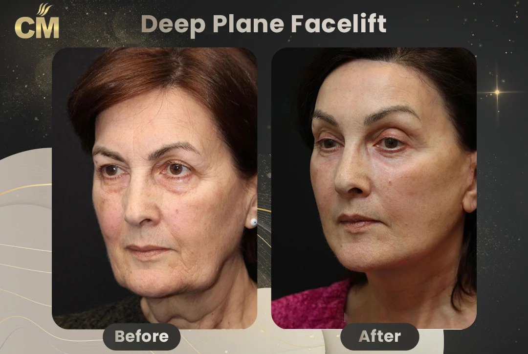 Deep Plane FaceLift Before After-5