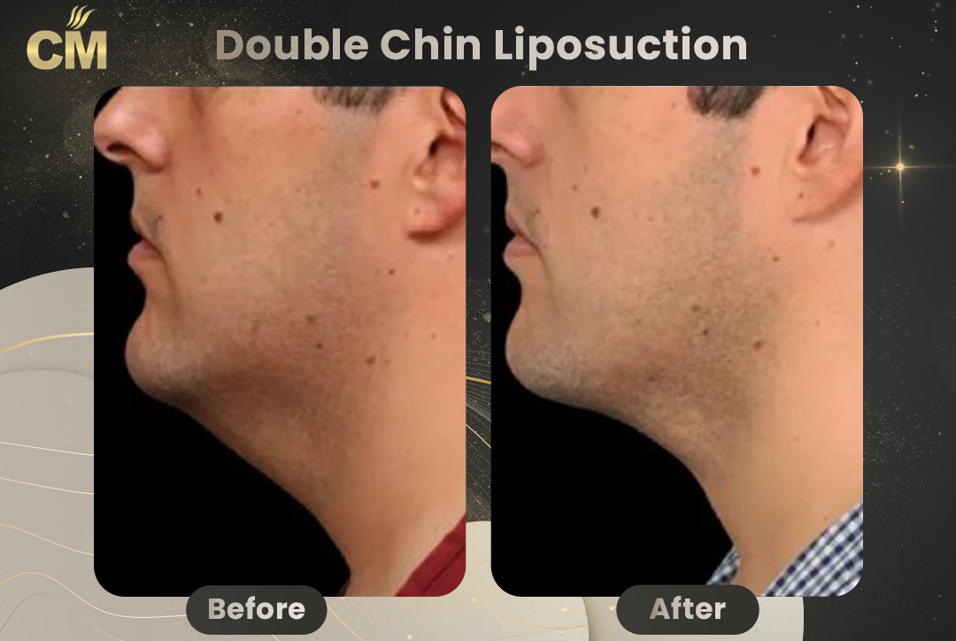 Double Chin Liposuction Before After for men