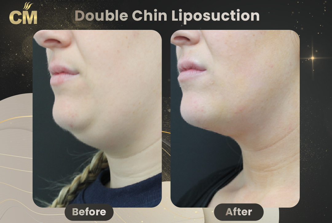 Double Chin Liposuction Before After