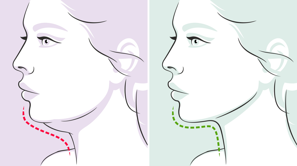 Double Chin Surgery in turkey 