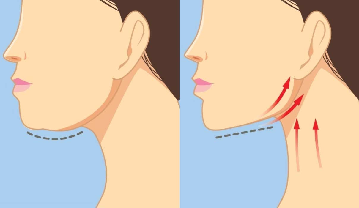 Double Chin Surgery b a 