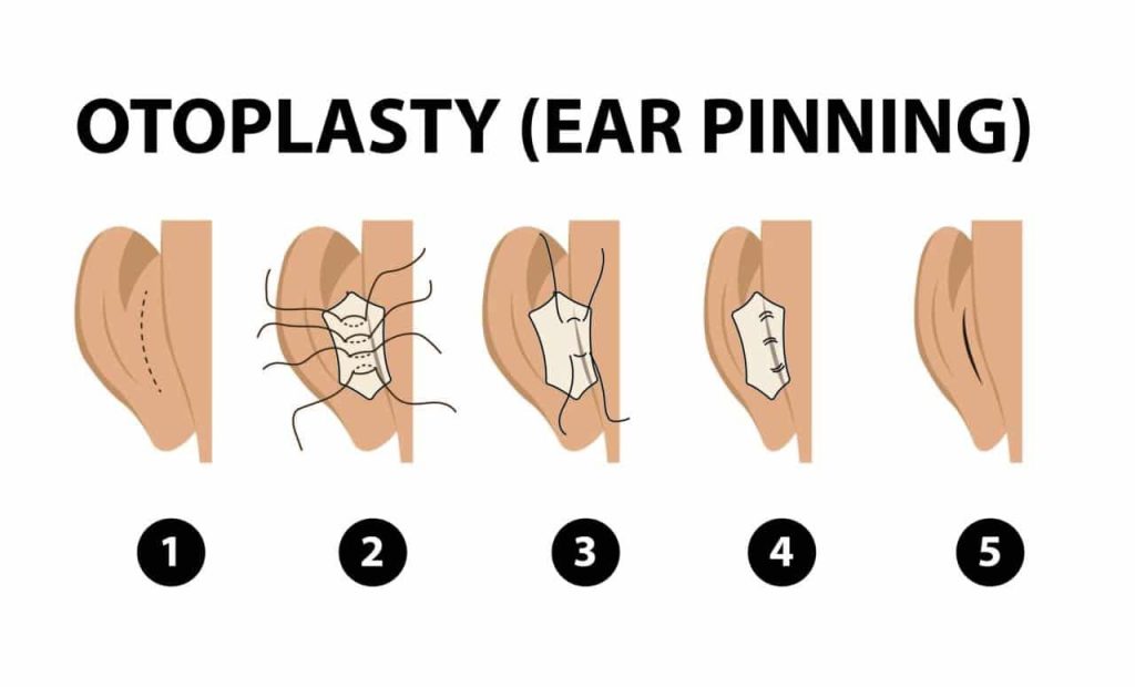 Ear pinning Otoplasty