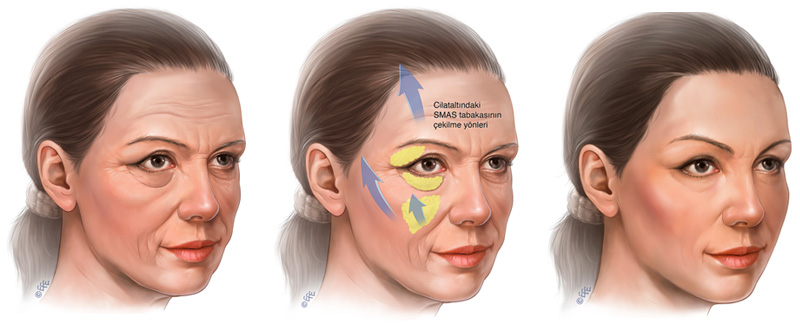 Endoscopic Mid Facelift surgery