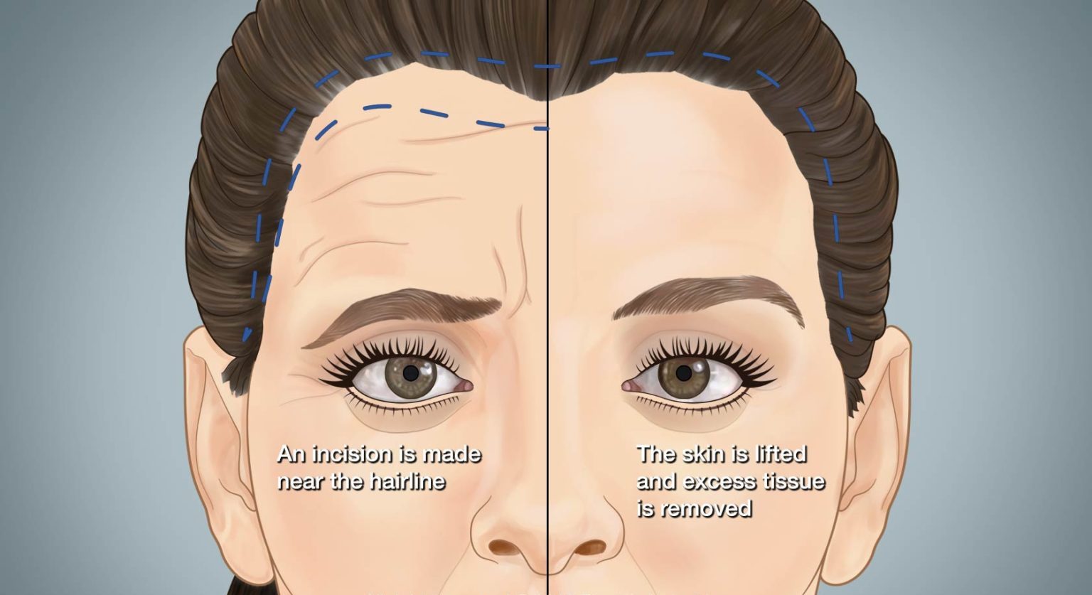 Eyebrow Lift Surgery in Turkey