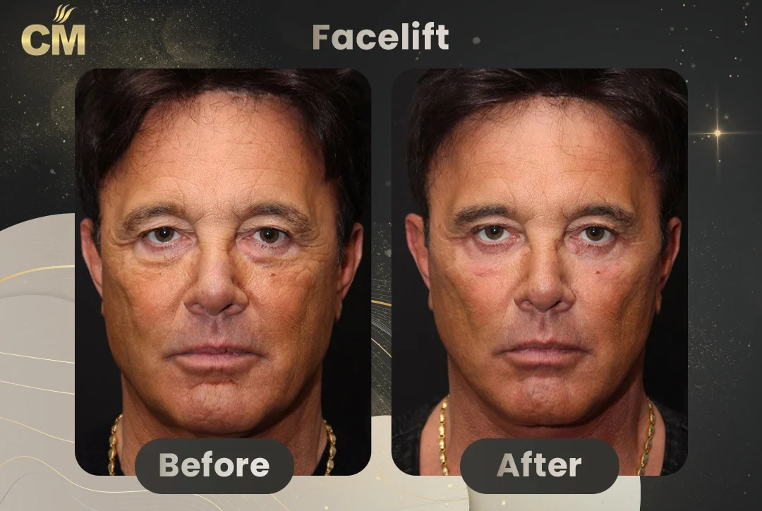 men Facelift Before and After