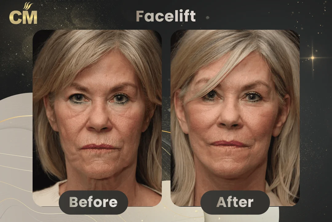women Facelift Before and After