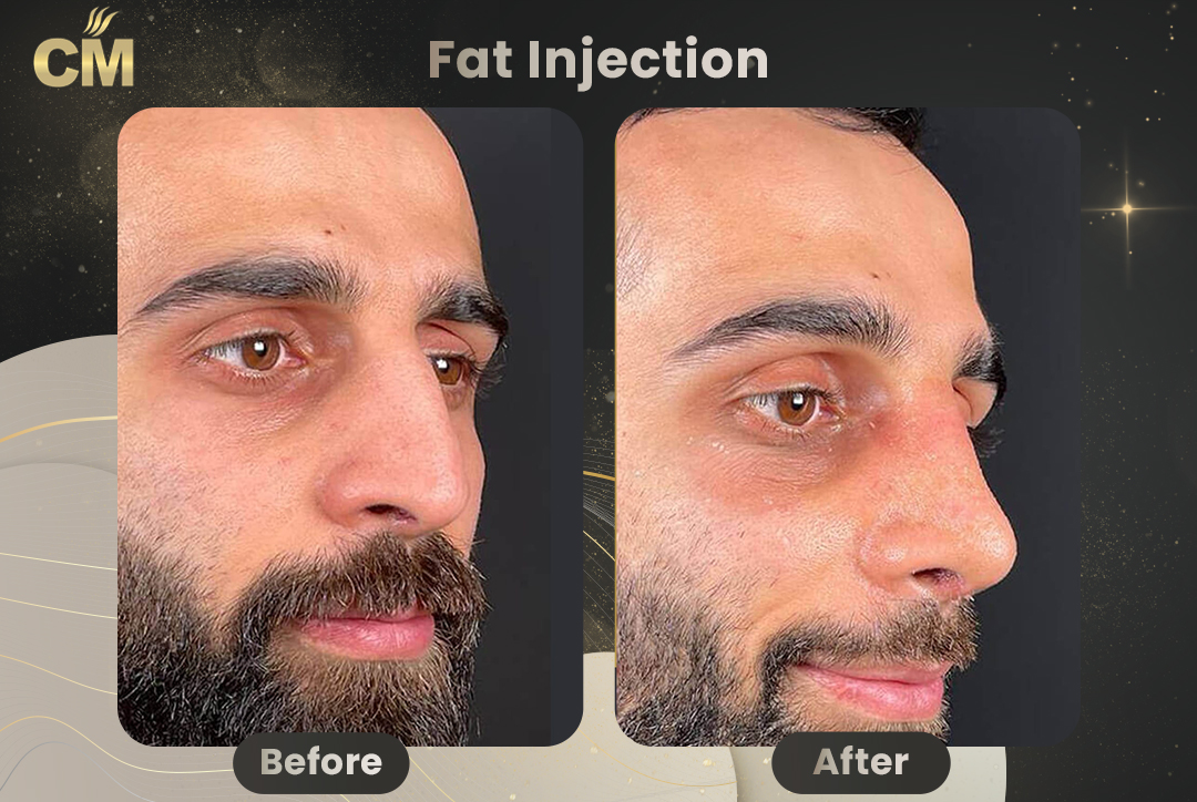 Fat Injection Before After in Turkey for men