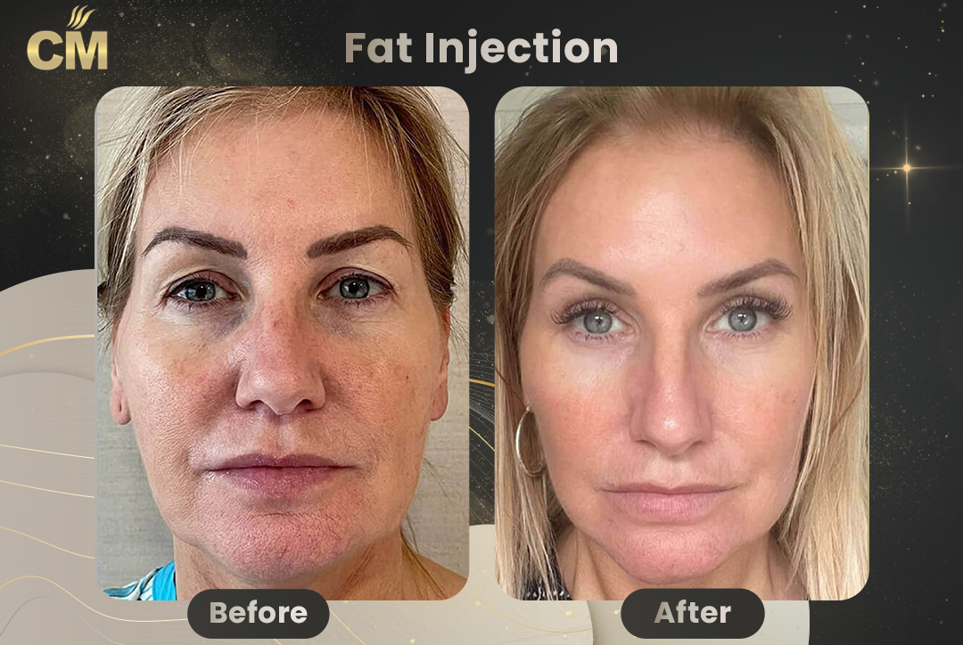 Fat Injection Before After in Turkey for women
