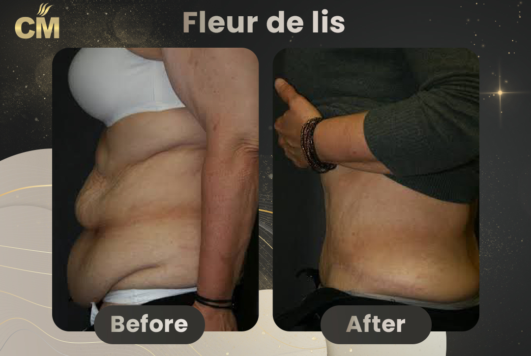 Fleur de lis abdominoplasty Before After-5