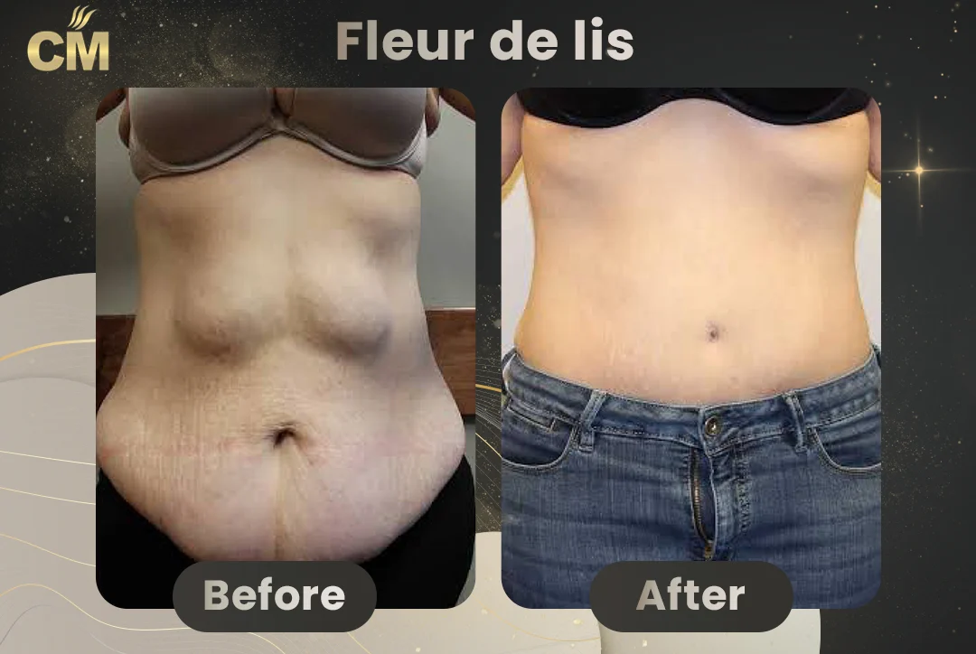 Fleur de lis abdominoplasty Before After-4