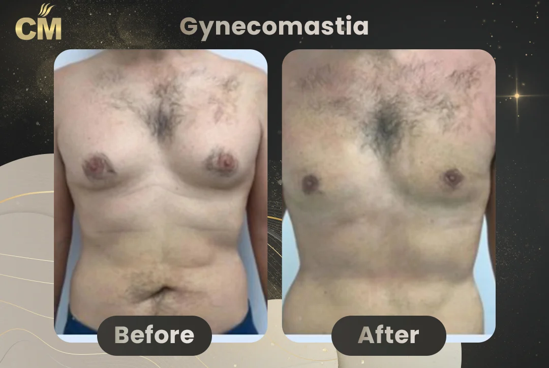 Gynecomastia Before After-1