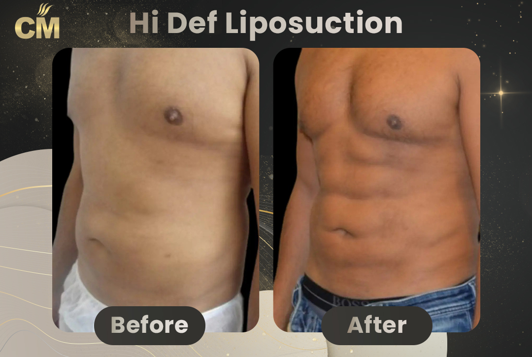 Hi Def Liposuction Before After1