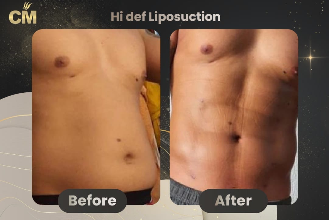 Hi Def Liposuction Before After