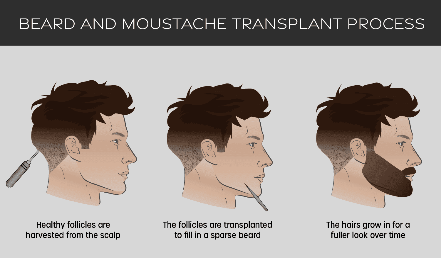 How is Beard Transplant Performed
